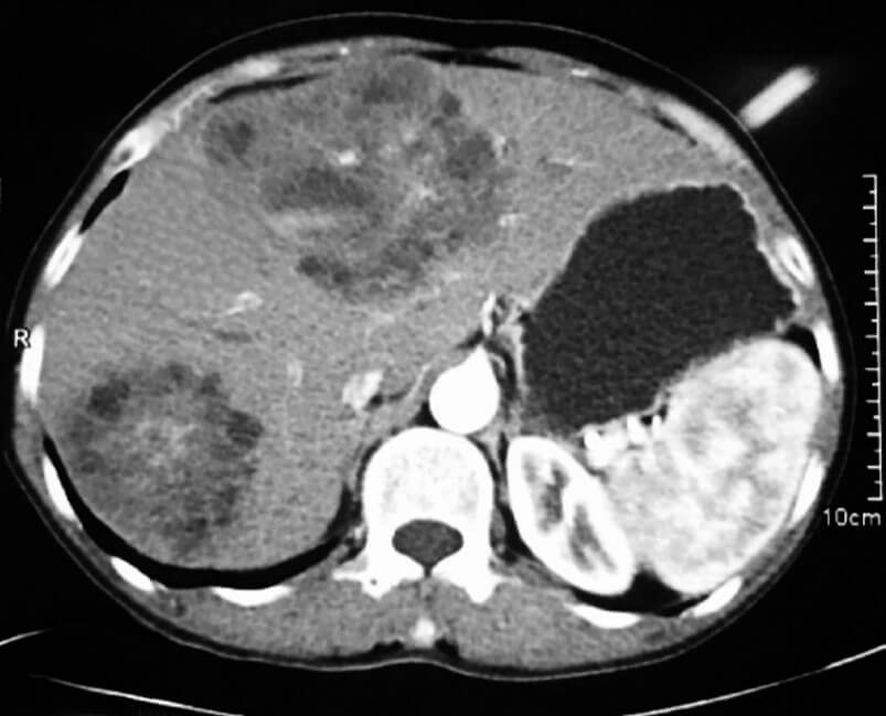 Management of Hepatic Hydatid Disease - Current Surgical Practice ...