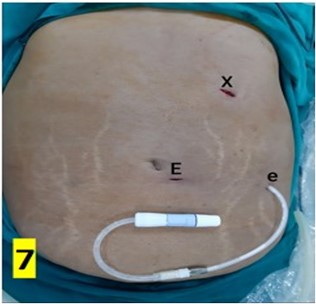 Modified Single Port Laparoscopic Peritoneal Dialysis Catheter ...